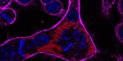 A giant cell resulting from Burkholderia infection undergoing abortive cell division.