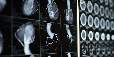 coronary heart disease diagnosis