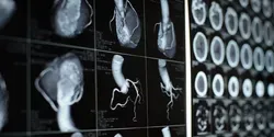 coronary heart disease diagnosis