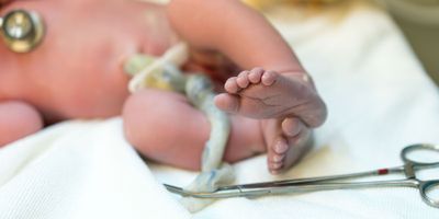 umbilical cord being cut