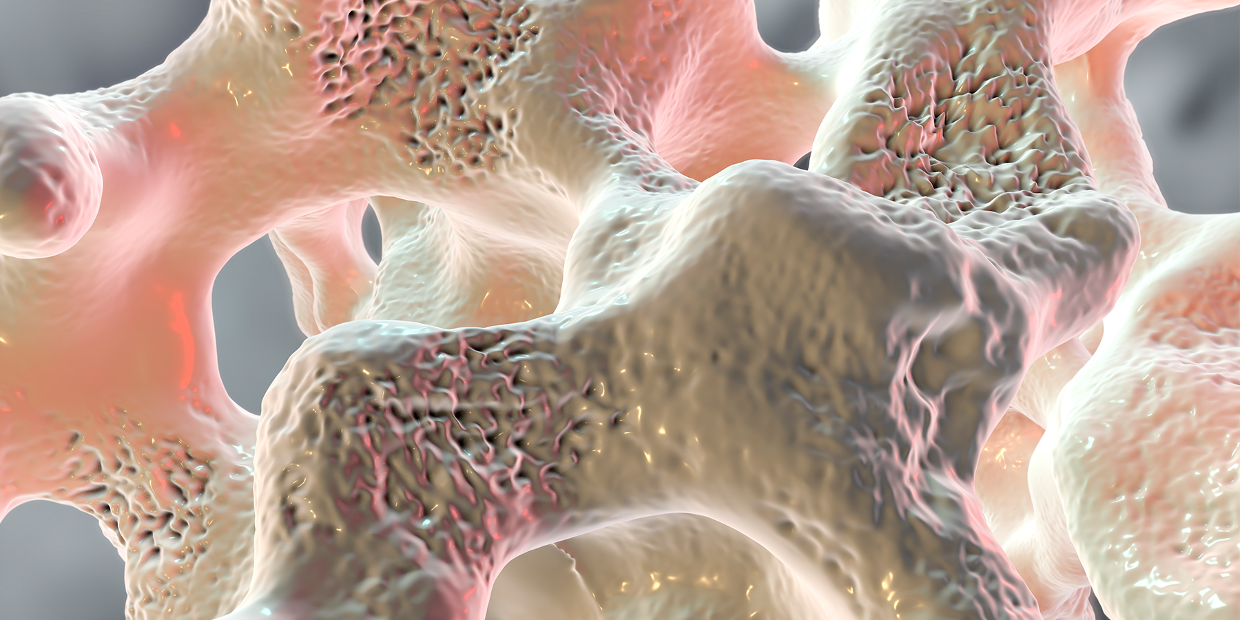 osteoporosis