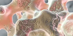 osteoporosis
