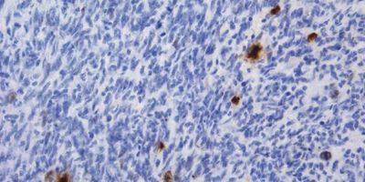 Temozolomide Gliomas, CNIO