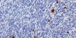 Temozolomide Gliomas, CNIO