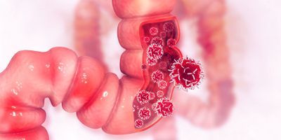 colon cancer illustration