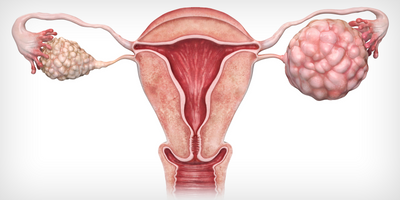 ovarian cancer illustration
