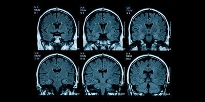 brain MRIs