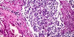 non-small cell lung cancer
