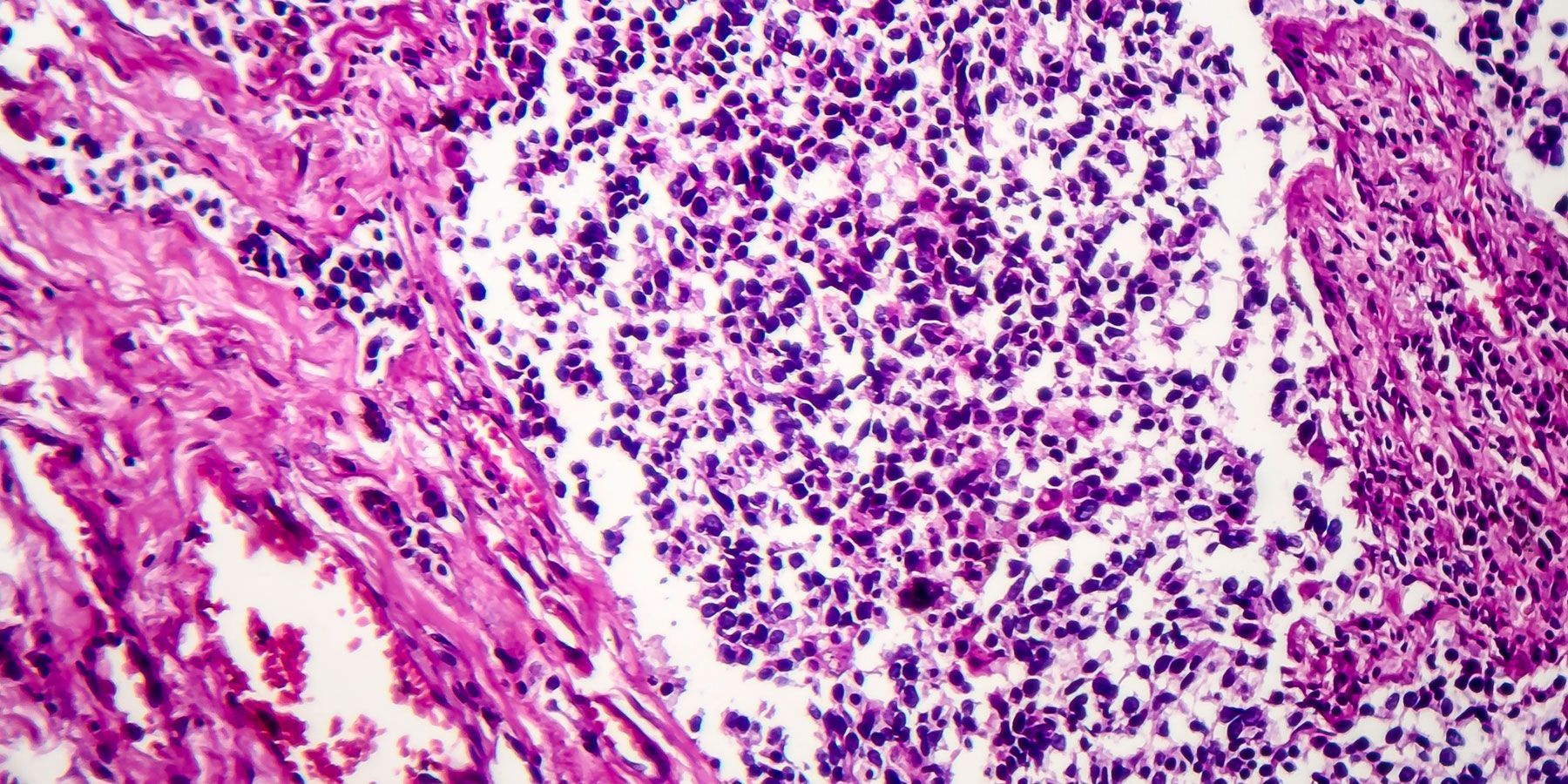 non-small cell lung cancer