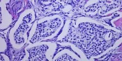 pancreatic tumor
