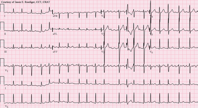 Big-Data Study Pinpoints More Than 150 Genes Associated with Atrial Fibrillation