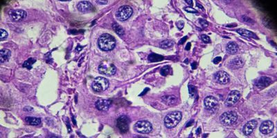 Hepatocellular carcinoma, HCC under microscopy stock photo