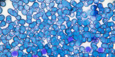 Acute lymphoblastic leukemia ALL-L2 blood smear under light microscopy