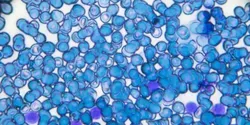 Acute lymphoblastic leukemia ALL-L2 blood smear under light microscopy