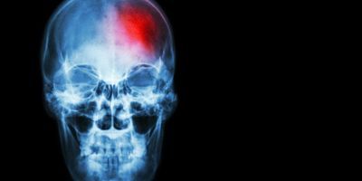 Stroke diagnostic tool