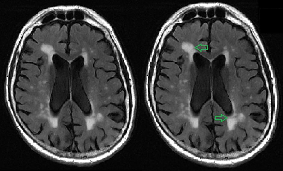 White matter brain lesion MRI