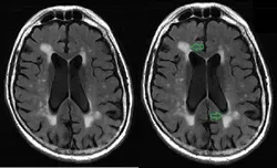 White matter brain lesion MRI