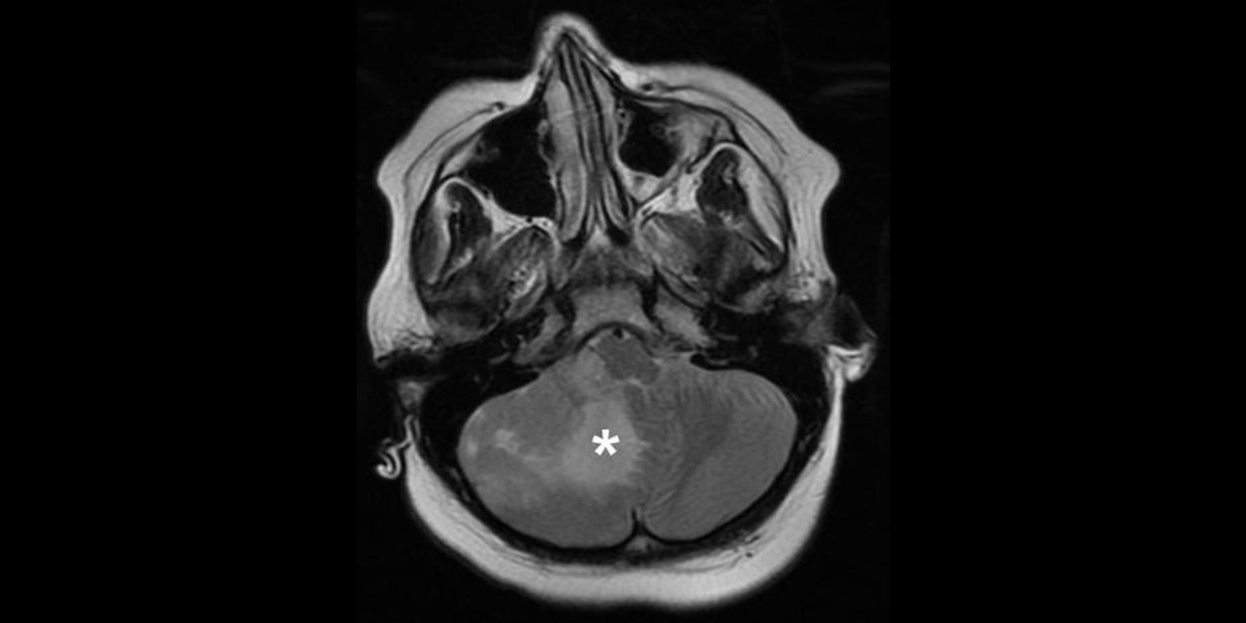 Brain Scan Medulloblastoma Brain Scan Medulloblastoma