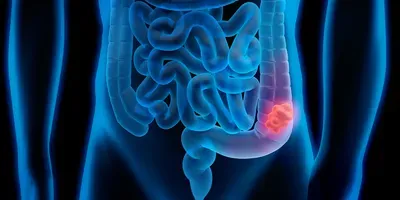 Image of colon cancer scan