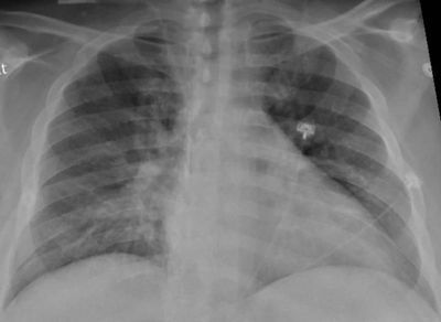 Lung X-ray COVID-19
