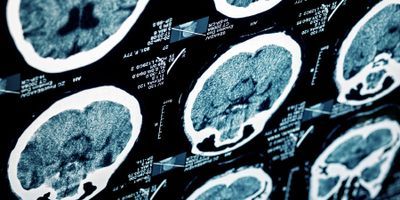 picture of a brain scan