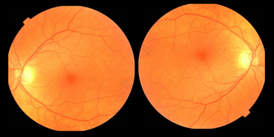 Retina scan showing the fundus of the eye