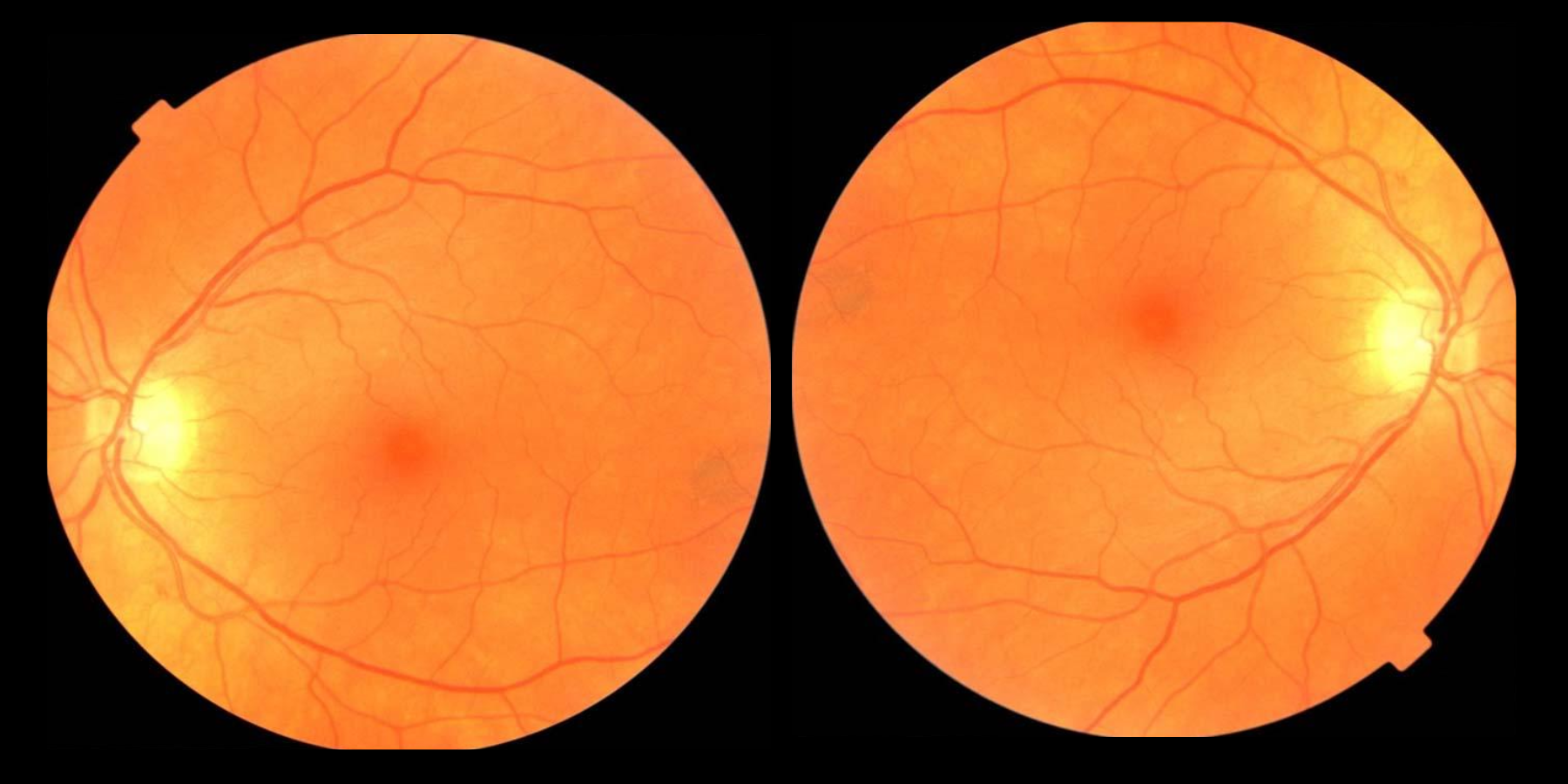 Retina scan showing the fundus of the eye Retina scan showing the fundus of the eye