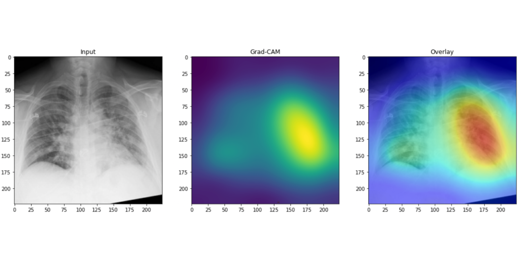 Chest X-ray of COVID-19 positive patient