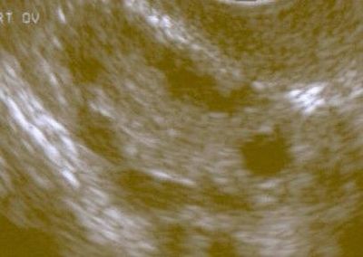 Researchers Identify Causes and Mechanisms of Polycystic Ovary Syndrome Using Family-Based Genetic Analysis