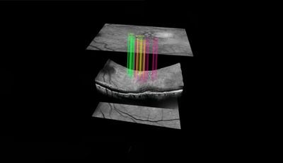 Example of the data from the DARC scans showing different layers of the retina superimposed with analysis from the AI wet AMD test