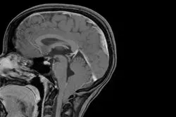 Image of an MRI brain scan showing evidence of a Chiari 1 malformation