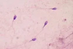 Human sperm stained for semen quality testing in the clinical laboratory