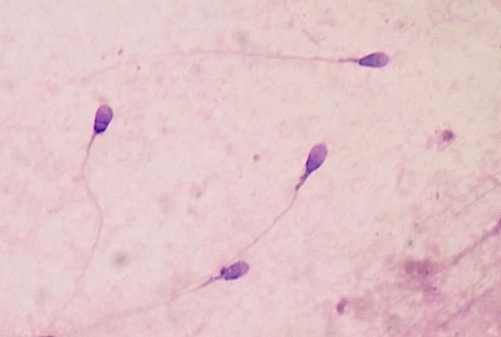 Human sperm stained for semen quality testing in the clinical laboratory Human sperm stained for semen quality testing in the clinical laboratory