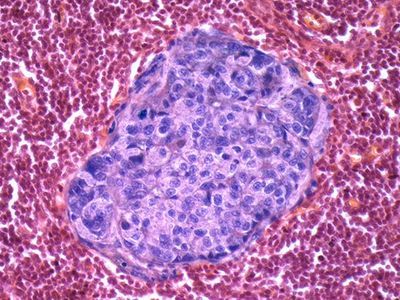 Review Identifies Four Hallmarks of Cancer Metastasis