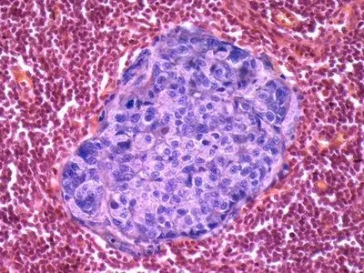 New Review Identifies Four Hallmarks of Cancer Metastasis | Today's ...