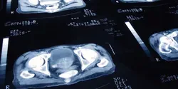 MRI scan of prostate cancer