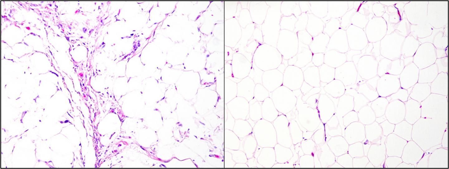 Atypical lipomatous tumor/well-differentiated liposarcoma (left-hand); lipoma (right-hand)