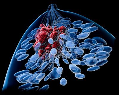 Molecular Imaging Determines Effectiveness of Novel Metastatic Breast Cancer Treatment