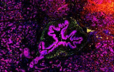 Pancreatic cells can become cancerous (magenta) when an inflammatory molecule called IL-33 activates signals within the pancreatic cells