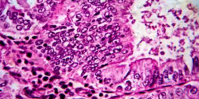 A photo showing a histological section of endometrial cancer