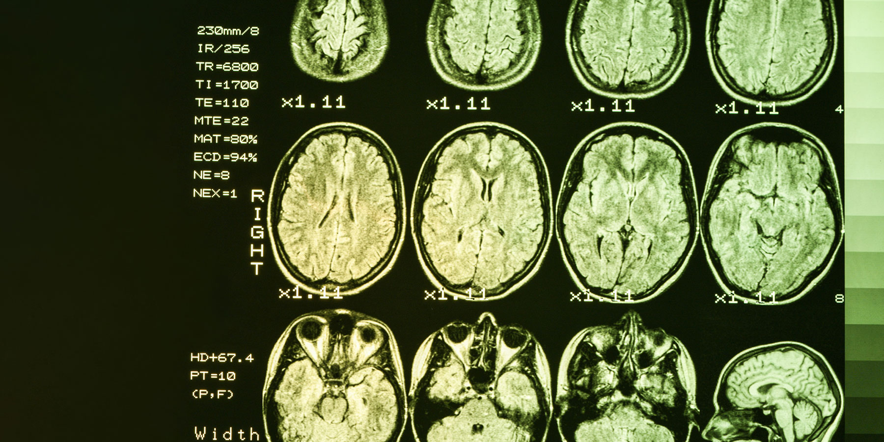 MRI human brain scans