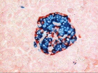 Advancing Cell Therapy for Diabetes