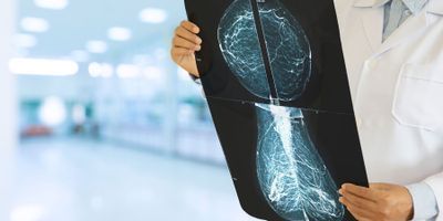 Health care professional holding an xray breast mammography in their hands