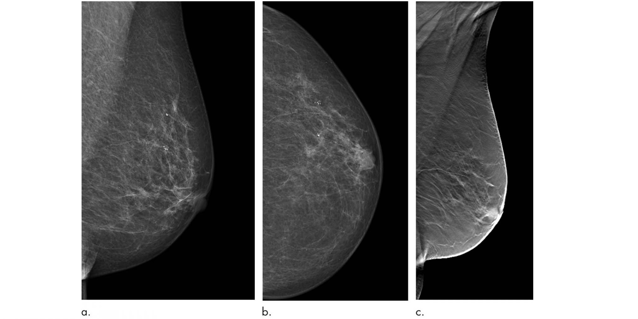 Photo of digital mammography results of the breast of a patient
