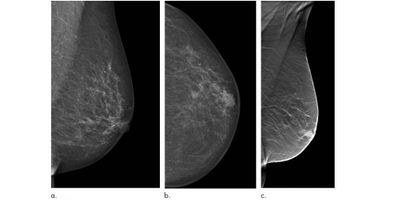 Photo of digital mammography results of the breast of a patient