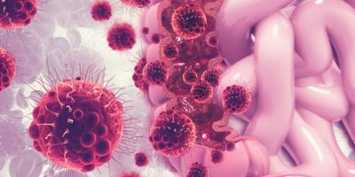 Illustration of cancer cells in colorectal cancer