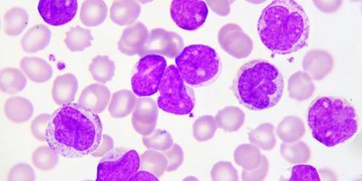 Photo of a stained blood smear showing acute myeloid leukemia round cells