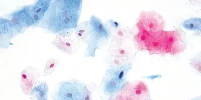 Illustration of a cervical cells from a Pap test stained for evaluation