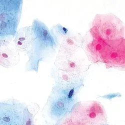 Illustration of a cervical cells from a Pap test stained for evaluation