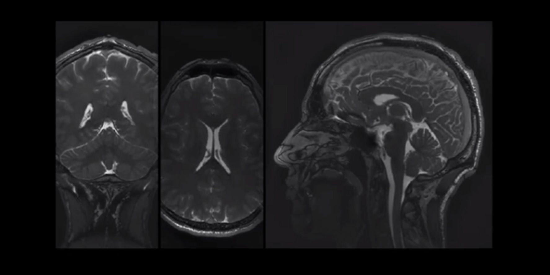 Photo of a sagittal cross-section of the human brain on a black background